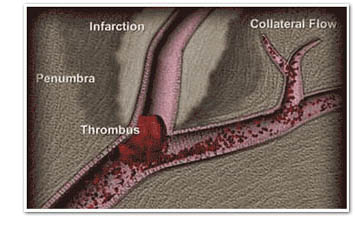 Ichemic Stroke