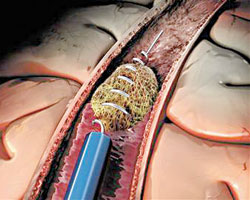 Mechanical Clot Retrieval