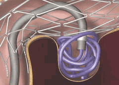 Stent-assisted aneurysm coiling