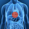 Paraesophageal Hernia
