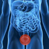 Inguinal Hernia