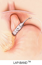 LAP-BAND