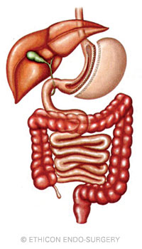 Sleeve Gastrectomy