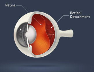 Detached Retina