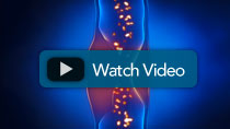 Spinal Stenosis Video