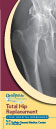 Total Hip Replacement Instructional Guide