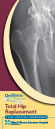 Total Hip Replacement Instructional Guide