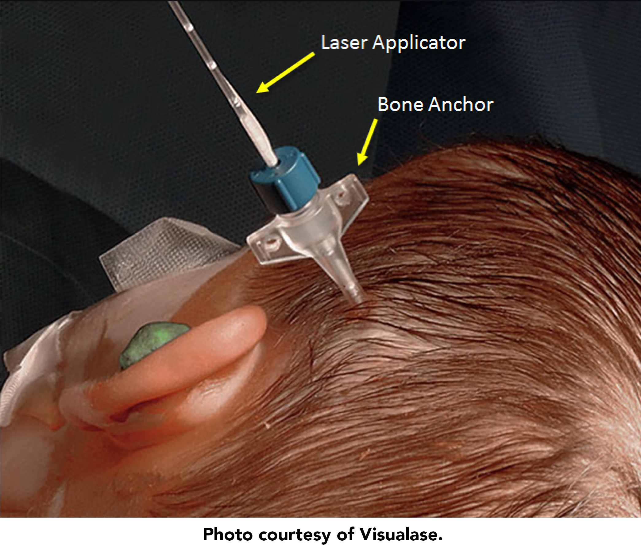 Epilepsy News & Updates Kaleida Health Buffalo, NY