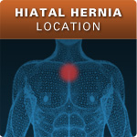 Hiatal Hernia Location