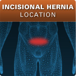 Incisional Hernia Location
