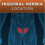 Inguinal Hernia Location